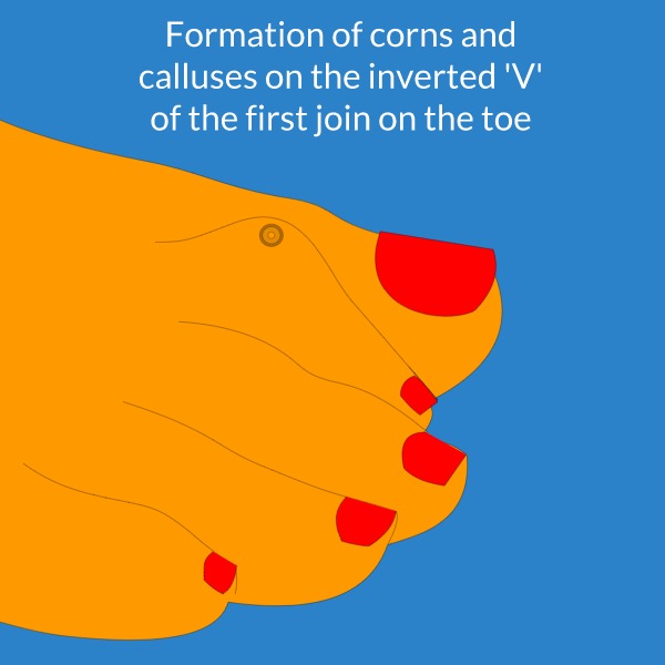 Hammer Toe can cause the formation of corns and calluses