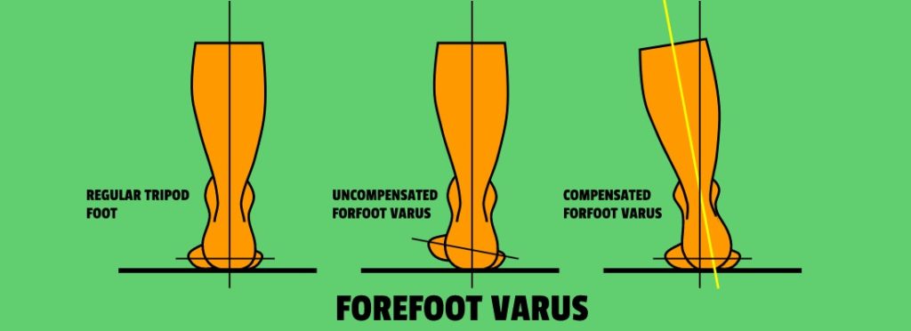 Foot Tripod Vs, Uncompensated Forefoot Varus Vs. Compensated Forefoot Varus