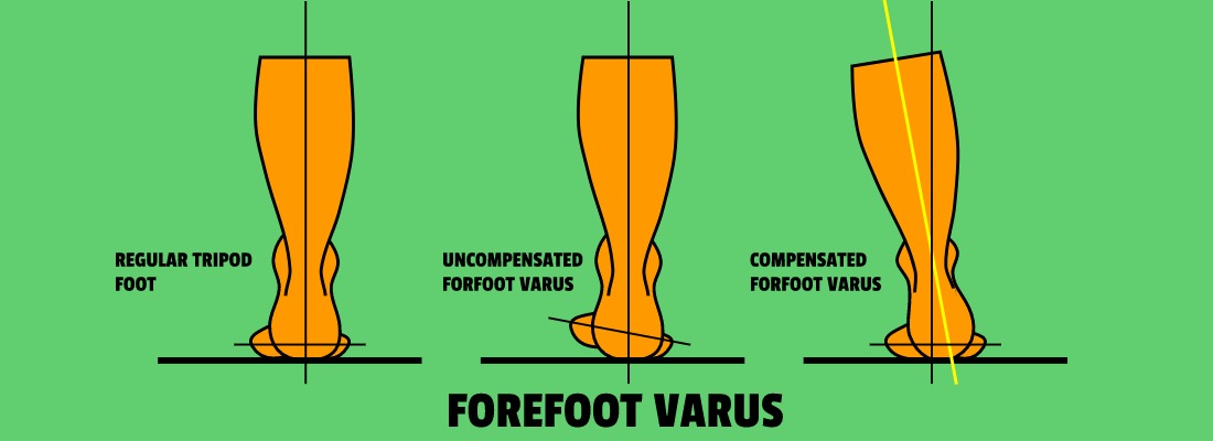 forefoot varus icd 10